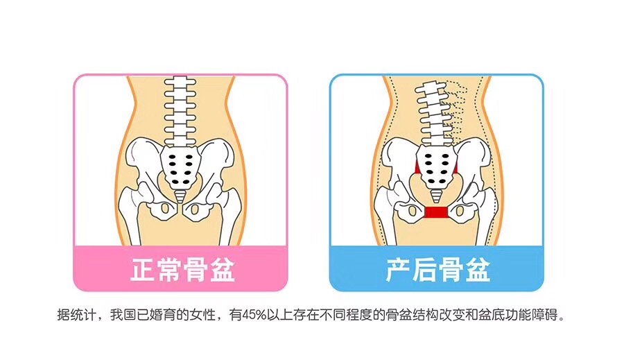 盆骨早闭合、早放心！！