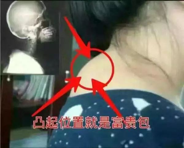 【唯美徒手整形】富贵包=夺命包！再不重视就晚