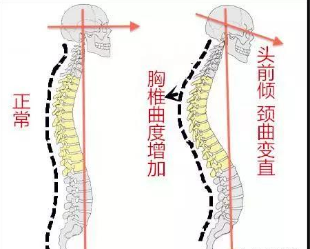 【唯美徒手整形】我们的脊椎为何如此脆弱？