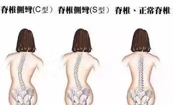 脊柱侧弯会有那些危害？